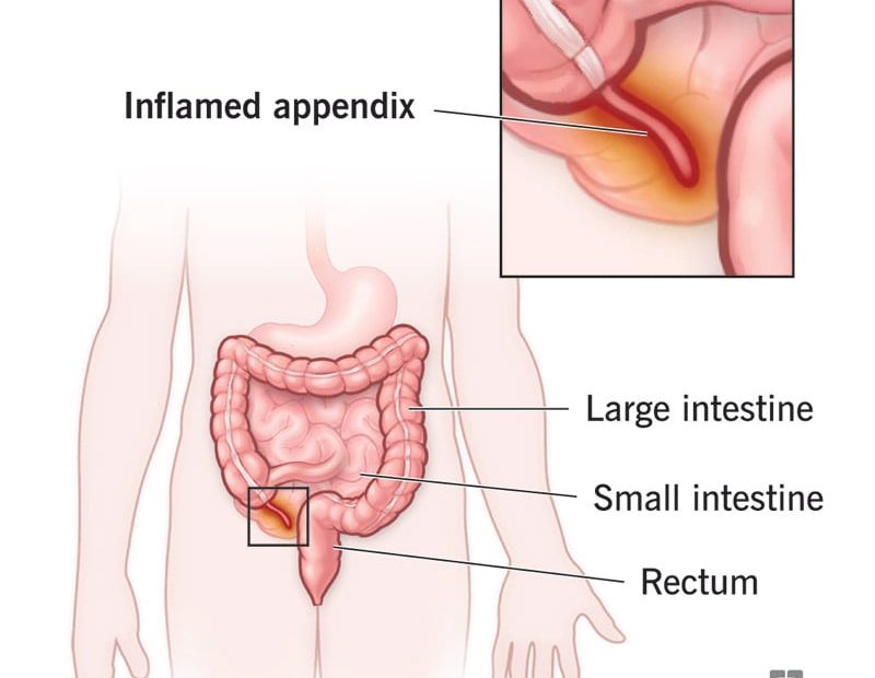 Appendicitis: Signs & Symptoms, Causes, Diagnosis & Treatment